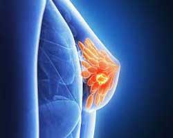 آیا کیست های غیر سرطانی پستان از نوع خوش خیم بزرگ می شوند؟