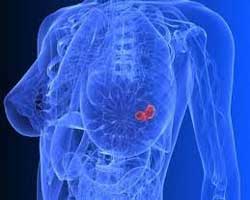 انواع سرطان سینه | سرطان پستان | جراح سینه
