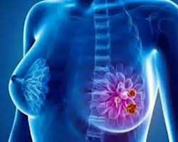 انواع سرطان پستان سینه | انواع سرطان سینه و زیرگروه های آن