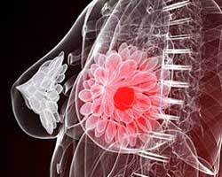 انواع نادر سرطان سینه کدام است؟
