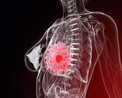 براکی تراپی یا پرتودرمانی داخلی برای سرطان سینه