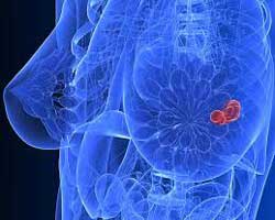 درمان سرطان پستان – جراحی سینه
