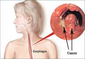 دکتر سرطان مری در شهرآرا | جراح سرطان مری در شهرآرا | فوق تخصص سرطان مری در شهرآرا | دکتر سرطان مری در شهرآرا | جراح عمومی در شهرآرا