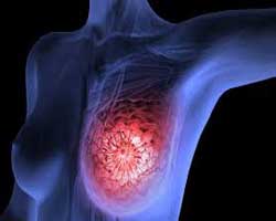 دکتر سرطان پستان و سینه در بوعلی | جراح سرطان پستان و سینه در بوعلی | فوق تخصص سرطان پستان و سینه در بوعلی | جراح عمومی