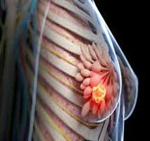 دکتر سرطان پستان و سینه در درکه | جراح سرطان پستان و سینه در درکه | فوق تخصص سرطان پستان و سینه در درکه | جراح عمومی