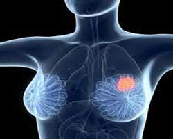 دکتر سرطان پستان و سینه در زرگنده
