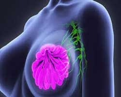 دکتر سرطان پستان و سینه در مرزداران