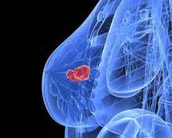 دکتر سرطان پستان و سینه در ملاصدرا