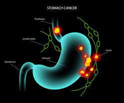 سرطان معده بدخیم