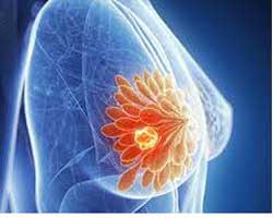 سرطان پستان و ماموگرافی