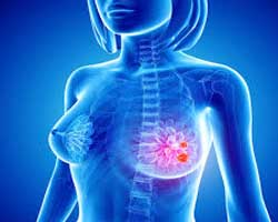 علائم سرطان سینه بدخیم | علائم و نشانه های سرطان پستان