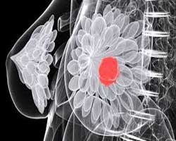 علایم سرطان سینه چیست و درمان سرطان سینه به چه شکل است؟