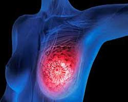 علت درد یک طرفه پستان و لمس توده چیست؟
