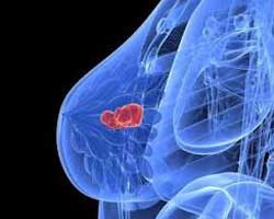 ماموگرافی در تشخیص سرطان پستان