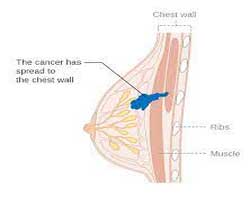 نحوه معاینه سرطان سینه در زنان