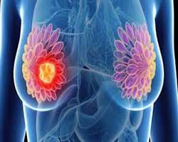 پرتودرمانی سرطان سینه | رادیوتراپی سرطان پستان