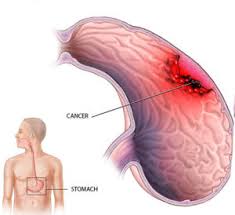 چه ازمایش سرطان معده را نشان می دهد