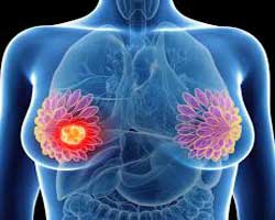 ژن درمانی در درمان سرطان | جدیدترین روش پیشگیری و درمان سرطان پستان