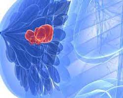 کدام مبتلایان به سرطان سینه باید شیمی درمانی شوند؟