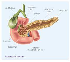 سرطان پانکراس در آزمایش خون