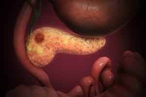 سرطان پانکراس و زردی پوست
