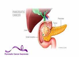 چه غذایی برای سرطان پانکراس مفید است
