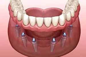 دندانپزشکی در هرندی