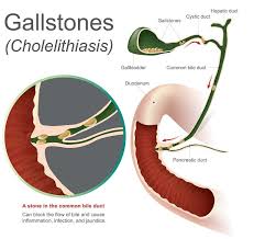 سنگ کیسه صفرا و کمر درد | سنگ کیسه صفرا و درمان | سنگ کیسه صفرا و یبوست | سنگ کیسه صفرا و کبد چرب | سنگ کیسه صفرا و بارداری | کیسه صفرا