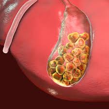 سنگ کیسه صفرا | سنگ کیسه صفرا و جراحی | چگونه از سنگ کیسه صفرا جلوگیری کنیم | سنگ کیسه صفرا حتما باید عمل شود | سنگ کیسه صفرا حاد