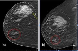 birads 4 mri | birads4b | birads 0 در ماموگرافي | birads iv چیست | birads 4 mri | | birads iv چیست | birads 4 mri