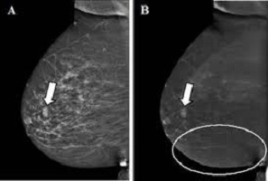 birads iv چیست birads 4 mri | birads4b | birads 0 در ماموگرافي | birads iv چیست | birads 4 mri | birads iv چیست