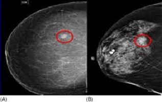 سرطان الثدي عند النساء واعراضه