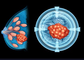 سرطان الثدي من الدرجة الثانية