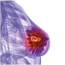 best breast cancer surgeon in ahmedabad