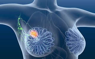 breast cancer surgeon in delhi