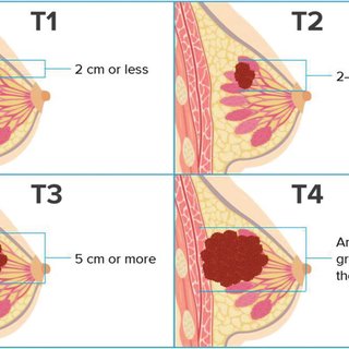 best breast cancer surgeon in india