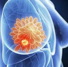 best breast cancer surgeon in mumbai