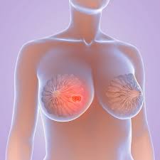 best breast cancer surgeon in rochester ny