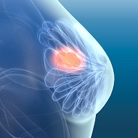 best breast cancer surgeon london