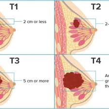 best breast cancer surgeon melbourne