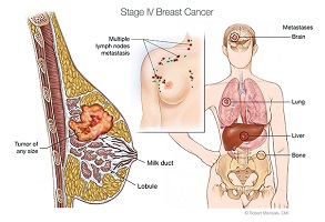 breast cancer plastic surgeon