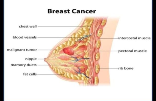 breast cancer reconstruction plastic surgeon