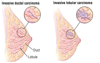 breast cancer surgeon adelaide