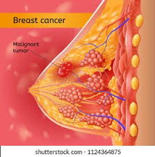 breast cancer surgeon anchorage