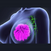 breast cancer surgeon asheville nc