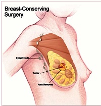 breast cancer surgeon charlotte nc