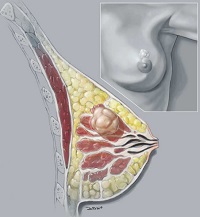 breast cancer surgeon denver