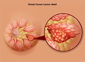 breast cancer surgeon idaho falls