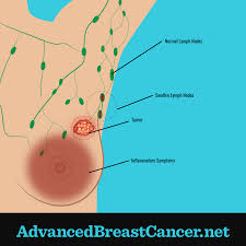 breast cancer surgeon in pune