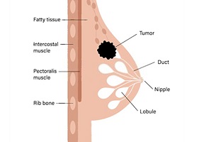 breast cancer surgeon mississauga